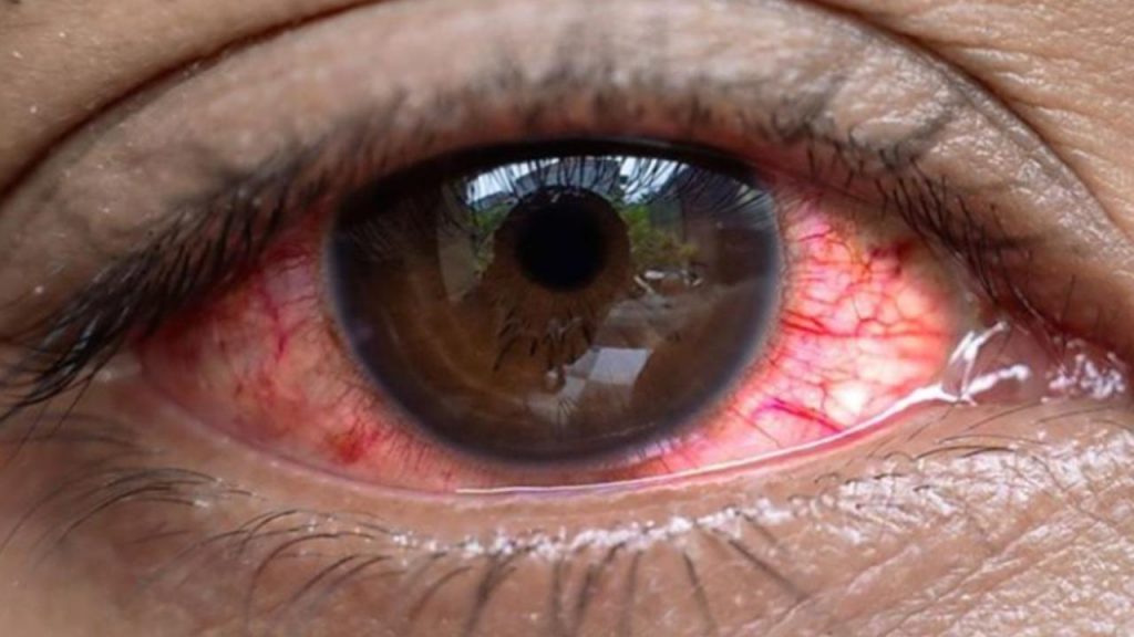 
                        Uganda’da salgın: 7 bin 500 kişide “kırmızı göz” hastalığı görüldü        